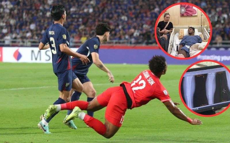 Cầu thủ bị chấn thương ống đồng khi đá bóng trong trận đấu
